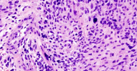 microscopic image of glioma brain tumor
